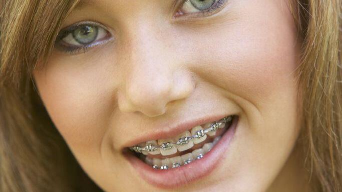Ab 1. Juli kommt die Gratis-Zahnspange, aber nicht für alle Jugendlichen