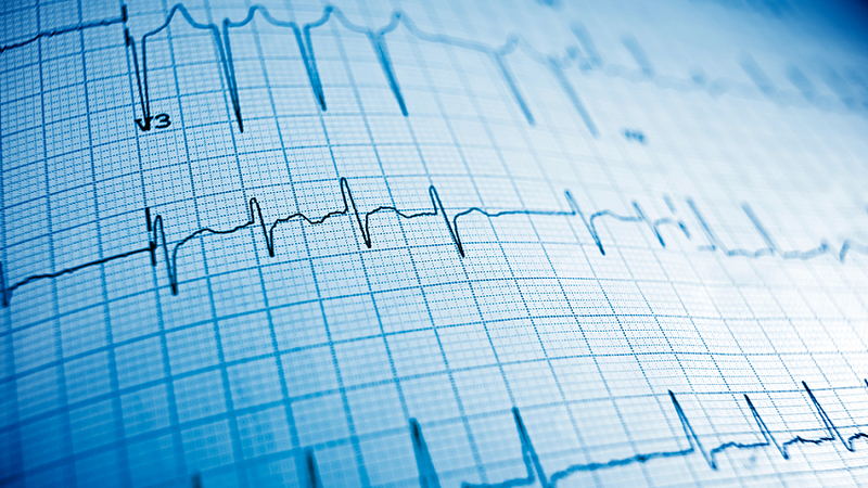 Stummer Herzinfarkt – weit verbreitet, wenig untersucht