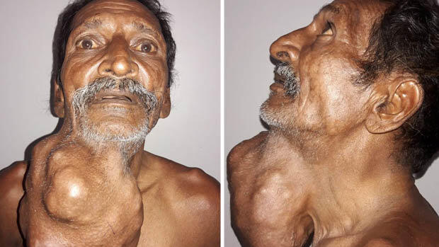 Inder überlebte 1,4 Kilo schweren Tumor am Hals